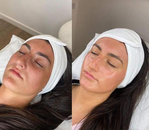 عکس قبل و بعد پاکسازی صورت در ارایشگاه