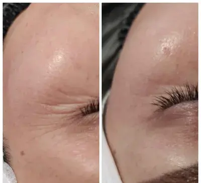 عکس قبل و بعد پاکسازی صورت در ارایشگاه