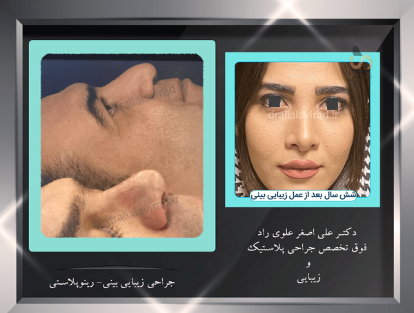 عکس صبا راد قبل از عمل بینی
