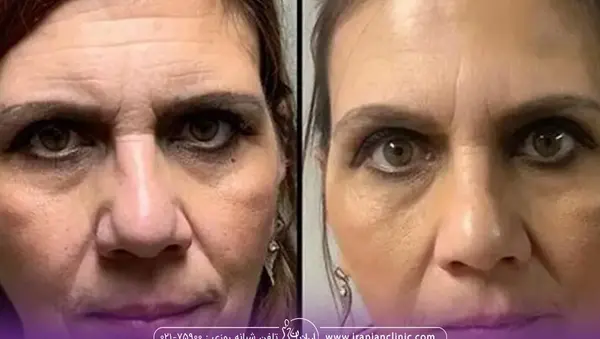 عکس قبل و بعد بوتاکس کل صورت