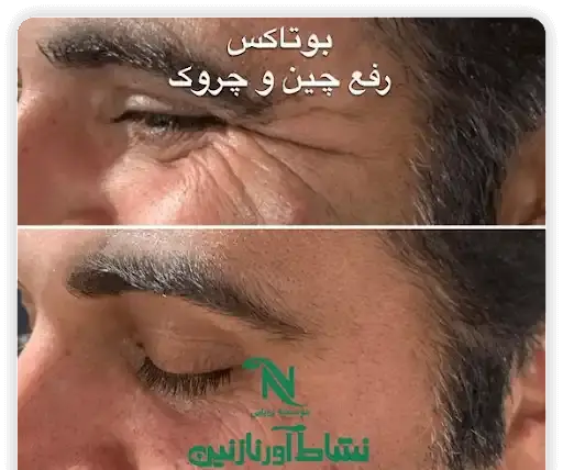 عکس قبل و بعد بوتاکس کل صورت