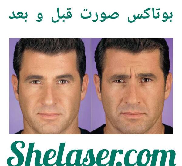 عکس قبل و بعد بوتاکس کل صورت