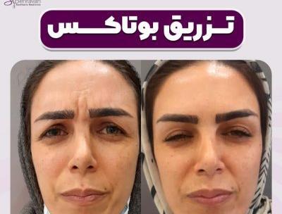 عکس قبل و بعد بوتاکس کل صورت