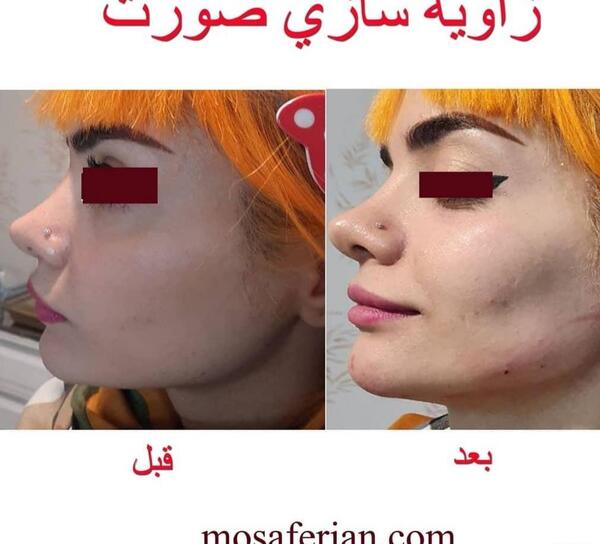 عکس قبل و بعد تزریق ژل به صورت