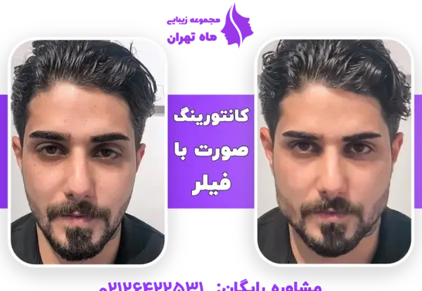 عکس قبل و بعد تزریق ژل به صورت