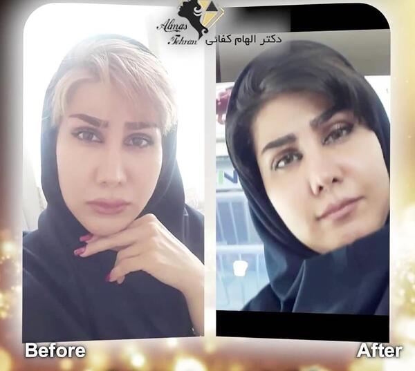 عکس قبل و بعد تزریق ژل به صورت