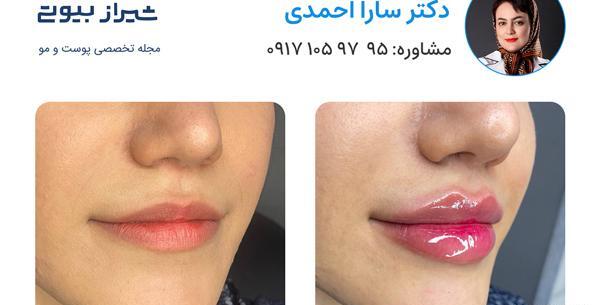 عکس قبل و بعد تزریق ژل به صورت