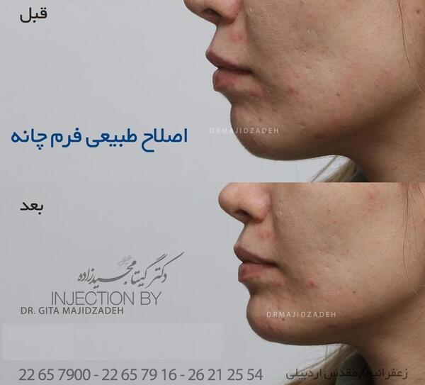 عکس قبل و بعد تزریق ژل چانه