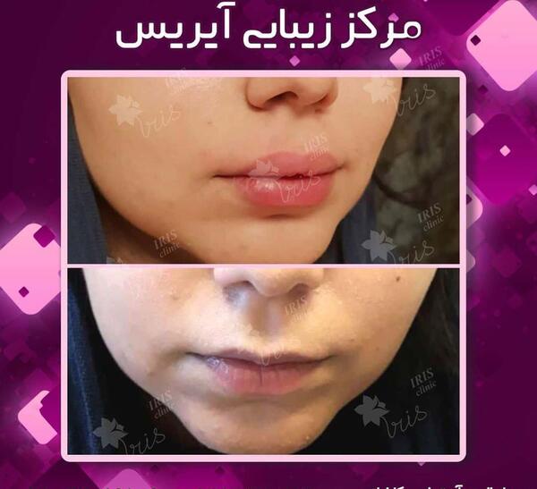 عکس قبل و بعد تزریق ژل چانه