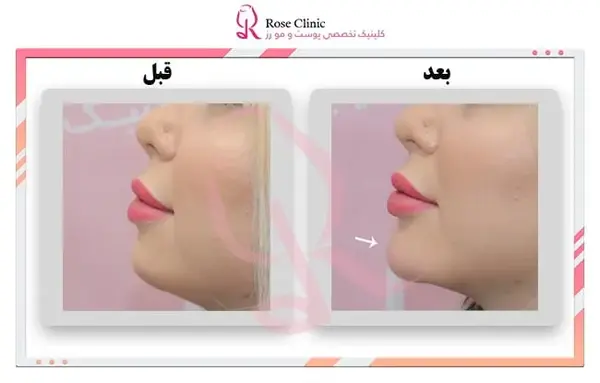 عکس قبل و بعد تزریق ژل چانه
