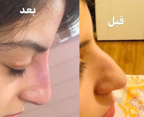 عکس قبل و بعد تزریق ژل چانه