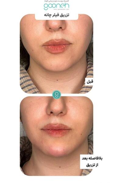 عکس قبل و بعد تزریق ژل چانه