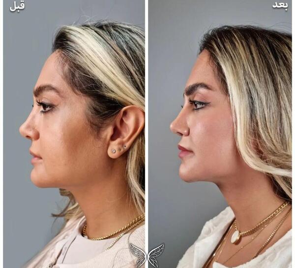 عکس قبل و بعد تزریق ژل چانه