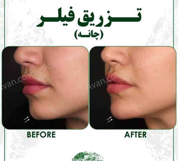 عکس قبل و بعد تزریق ژل چانه