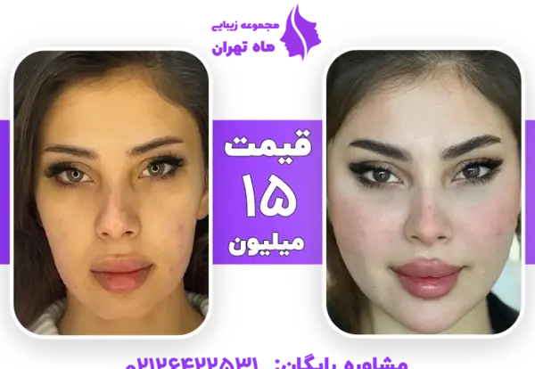 عکس قبل و بعد تزریق ژل چانه