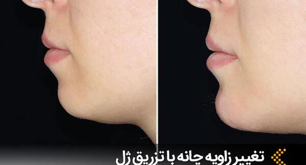 عکس قبل و بعد تزریق ژل چانه