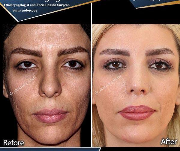 عکس قبل و بعد تزریق ژل چانه