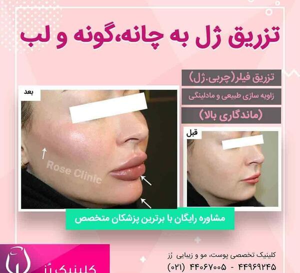 عکس قبل و بعد تزریق ژل چانه