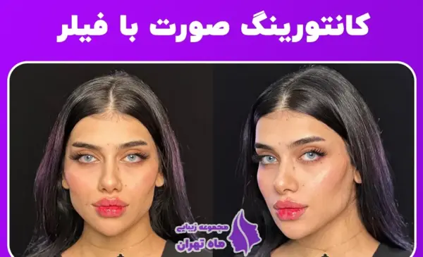 عکس قبل و بعد تزریق ژل چانه
