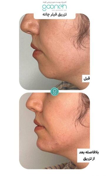 عکس قبل و بعد تزریق ژل چانه