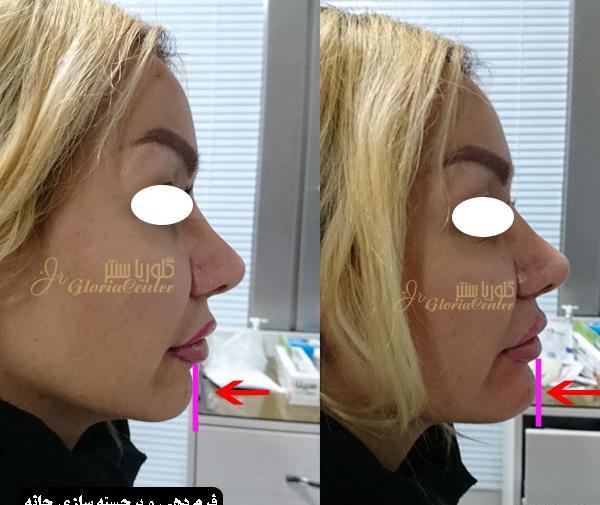 عکس قبل و بعد تزریق ژل چانه