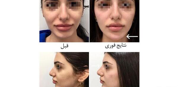 عکس قبل و بعد تزریق ژل چانه