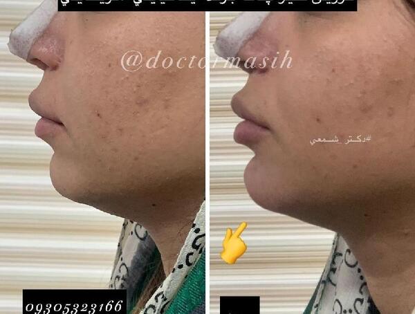 عکس قبل و بعد تزریق ژل چانه