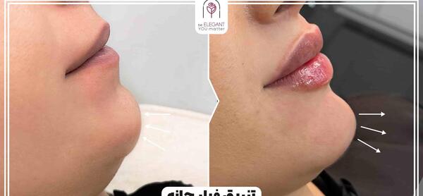 عکس قبل و بعد تزریق ژل چانه