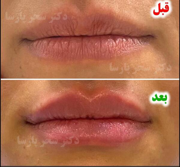 عکس قبل و بعد تزریق ژل صورت