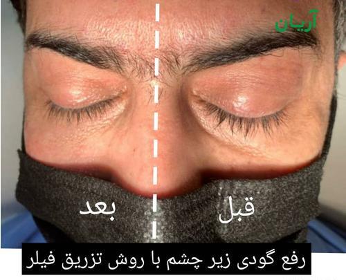عکس قبل و بعد تزریق ژل صورت