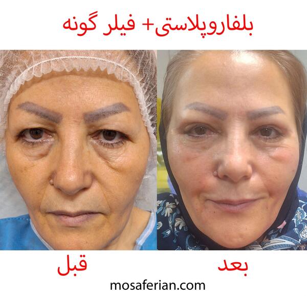 عکس قبل و بعد تزریق ژل صورت