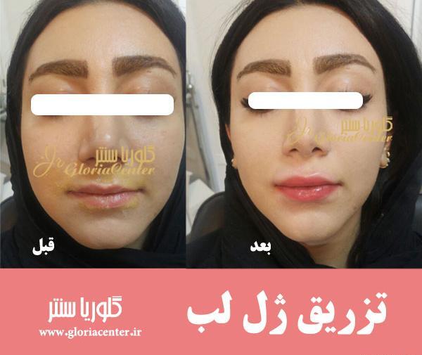عکس قبل و بعد تزریق ژل صورت