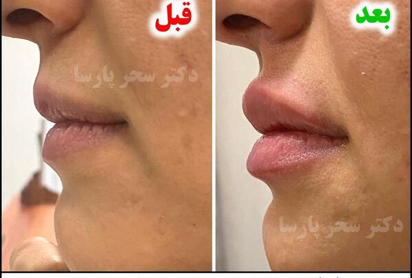 عکس قبل و بعد تزریق ژل صورت