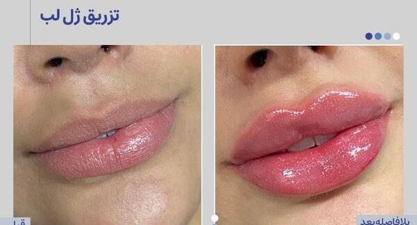 عکس قبل و بعد تزریق ژل صورت