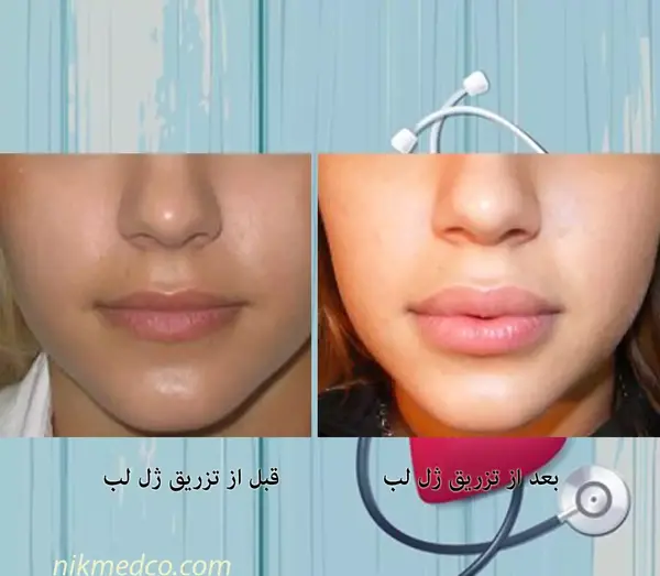عکس قبل و بعد تزریق ژل صورت