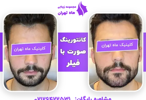 عکس قبل و بعد تزریق ژل صورت