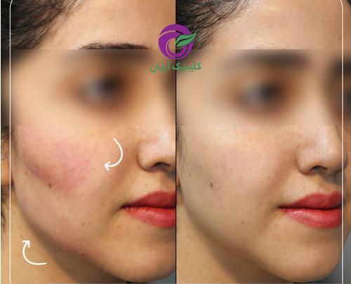 عکس های قبل و بعد از تزریق ژل گونه