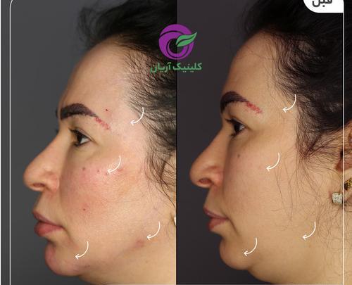 عکس های قبل و بعد از تزریق ژل گونه