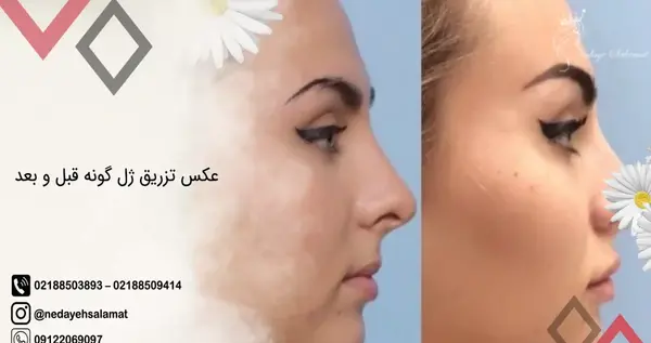 عکس های قبل و بعد از تزریق ژل گونه