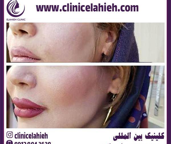 عکس های قبل و بعد از تزریق ژل گونه
