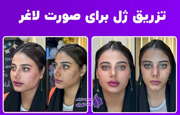 عکس های قبل و بعد از تزریق ژل گونه
