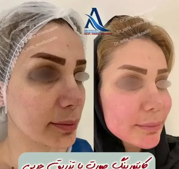 عکس تزریق ژل گونه قبل و بعد نی نی سایت
