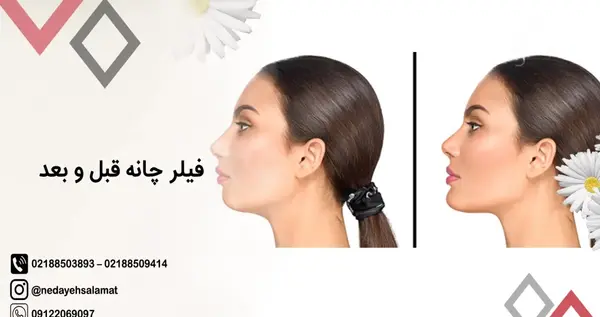 عکس تزریق ژل گونه قبل و بعد نی نی سایت