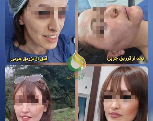 عکس تزریق ژل گونه قبل و بعد نی نی سایت