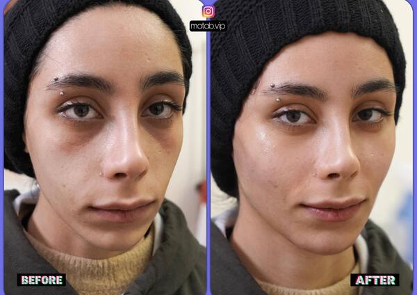 عکس تزریق ژل گونه قبل و بعد نی نی سایت