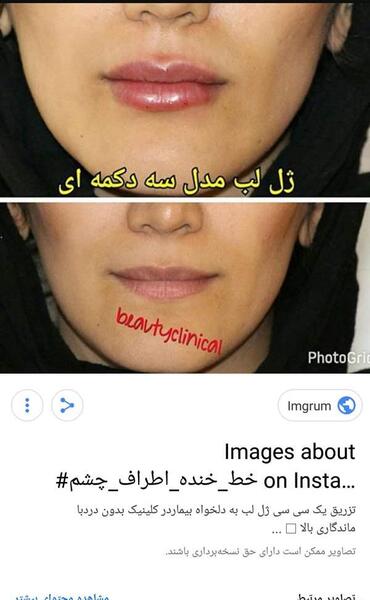 عکس تزریق ژل گونه قبل و بعد نی نی سایت