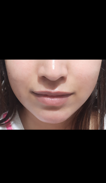 عکس تزریق ژل گونه قبل و بعد نی نی سایت