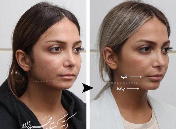 عکس تزریق ژل گونه قبل و بعد نی نی سایت