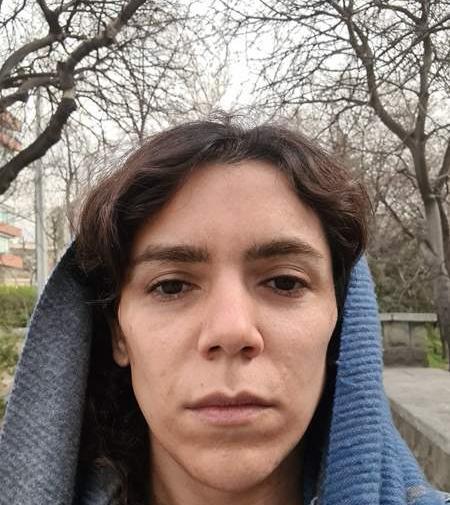 عکس تزریق ژل گونه قبل و بعد نی نی سایت