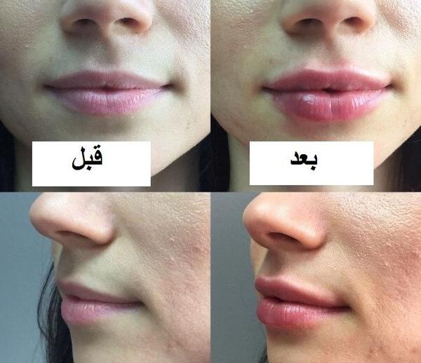 عکس قبل و بعد تزریق ژل به لب